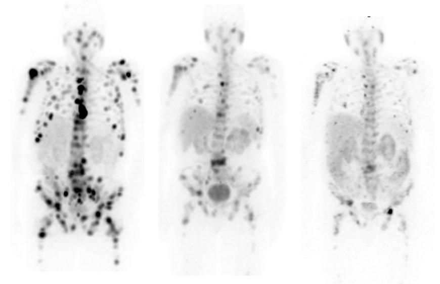 Healthcare Is Personal: GE Healthcare’s Total Molecular Imaging Solutions Enable Precision Health & Theranostics for Personalized Prostate Cancer Care